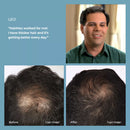 HairMax Ultima Classic LaserComb Bundle Medical Hair Growth Device